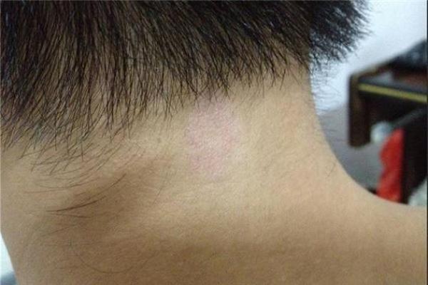 据脖子上胎记算命，有什么说法