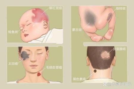 如何根据背部胎记算命-