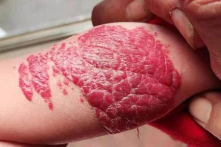 红色胎记算命分析