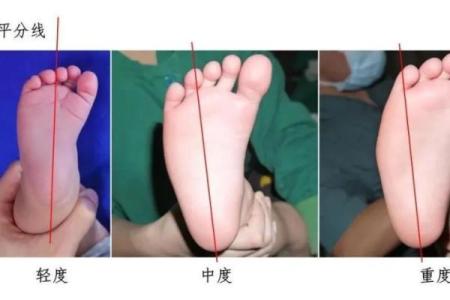 八字脚多的原因及如何缓解