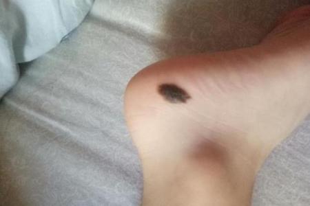 胎记的位置与运势算命