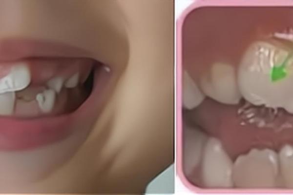 小孩外八字