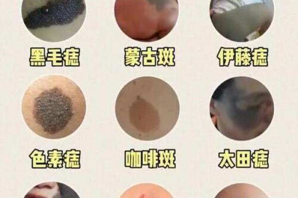 腿上胎记算命分析