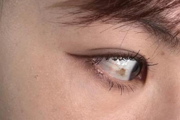 算命左眼白眼球有痣代