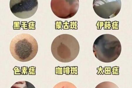 腿上胎记算命分析