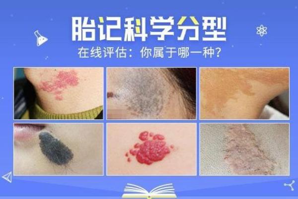 胎记释义，胎记算命中代表什么