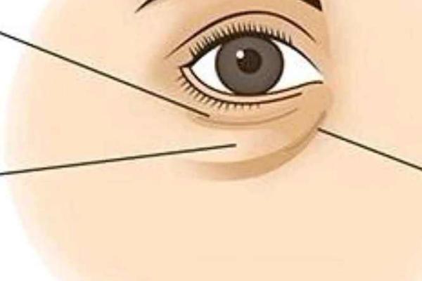 八字眼袋