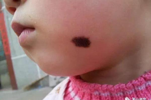 详解胎记算命
